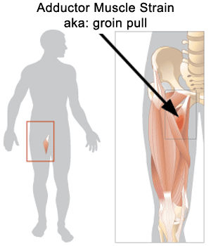 Adductor Strain.gif